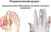 Артрит: причины, симптомы и лечение. Советы опытного врача