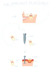 A detailed infographic-style illustration showing the process of dental implant placement, including a human jaw model with a missing tooth, the surgical insertion of the implant screw, the healing phase with bone integration, and the final crown attachment, all clearly labeled with simple anatomical diagrams and arrows indicating steps, set against a clean white background with medical precision