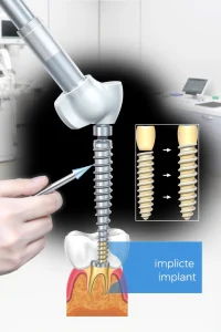 A detailed medical illustration showing a dentist performing dental implant surgery on a patient's jaw, with clear visualization of the implant being placed into the jawbone, surrounding gum tissue, and a cross-section view of the implant components including the screw and crown, in a clean clinical setting with medical equipment in the background