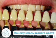 Photo of Все о восстановлении эмали зубов