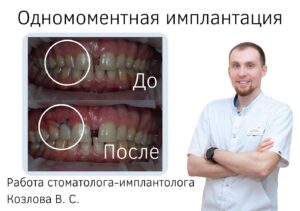 Имплантация зубов: основные преимущества