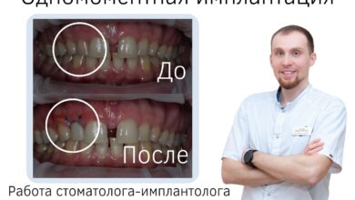 Photo of Имплантация зубов: основные преимущества