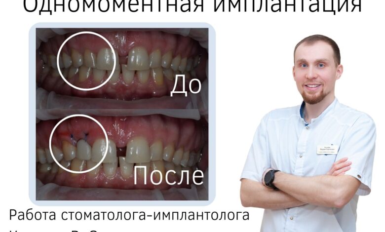 Имплантация зубов: основные преимущества