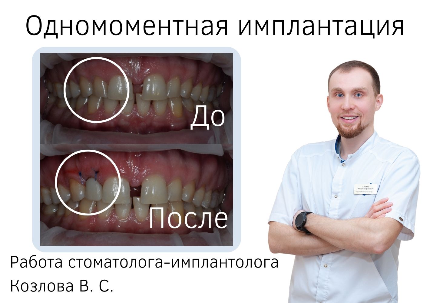 Имплантация зубов: основные преимущества