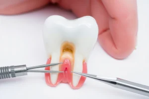 A close-up illustration of a human tooth with a missing dental crown, showing the exposed tooth structure and surrounding gum tissue, with a dental mirror and tweezers nearby on a clean white background, emphasizing dental care and urgency