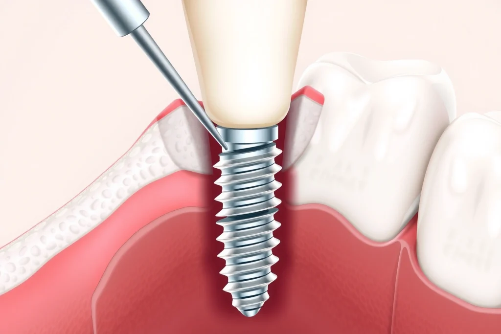A detailed medical illustration showing a dental implant being placed into a jawbone, with the implant is a titanium screw with a visible abutment and crown the surrounding bone and gum tissue are clearly visible with realistic textures and anatomical accuracy the background in soft neutral tones