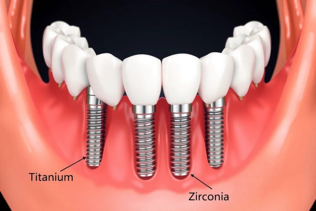 A close-up, detailed illustration of a human jaw with dental implants being placed, showing titanium and zirconia implant materials side by side in cross-section, with soft gum tissue and bone structure visible, clean clinical lighting, no text or labels