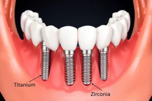A close-up, detailed illustration of a human jaw with dental implants being placed, showing titanium and zirconia implant materials side by side in cross-section, with soft gum tissue and bone structure visible, clean clinical lighting, no text or labels