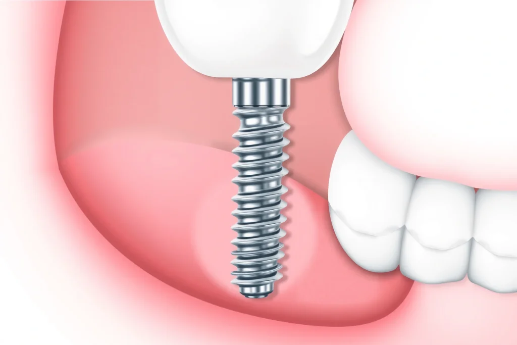 A close-up illustration of a dental implant in a human jaw, showing the titanium post integrated into the gum and bone, with a dental crown on top, surrounded by soft pink gums and subtle signs of healing, in a clean, clinical, and educational style