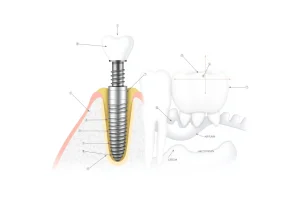 A detailed medical illustration showing the process of dental implantation: a cross-section of a jawbone with a titanium implant screw inserted into the bone, an abutment attached on top, and a ceramic crown placed above it, surrounded by healthy gum tissue; include subtle labels in a clean, professional medical diagram style without actual text or numbers visible — only symbolic markers like lines and dots to indicate parts; background is soft white or light gray to emphasize clarity