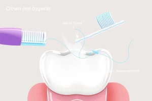 A close-up illustration of a dental crown on a tooth, showing proper oral hygiene tools like a soft-bristled toothbrush, dental floss, and interdental brush gently cleaning around the crown, with a clean, bright background and subtle glow emphasizing dental health and care