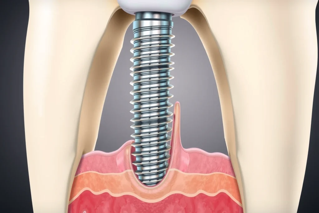 A detailed medical illustration of a dental implant being placed into a jawbone, showing the titanium implant screw integrated into the bone with surrounding gum tissue, cross-section of gum and bone layers, soft tissue healing around the abutment, and a crown visible above the gumline, all rendered in a clean, educational, anatomically accurate style with subtle lighting and neutral background