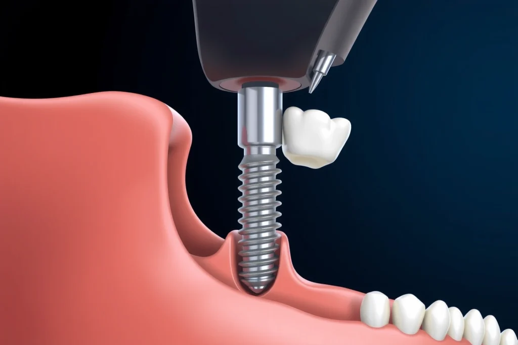 A close-up illustration of a human jaw with a dental implant being placed into the bone, showing the titanium post, abutment, and crown in cross-section, with soft tissue and bone structure visible, clean medical aesthetic, neutral background, no text or labels