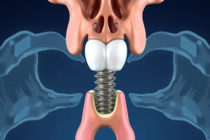 A detailed medical illustration showing a human jawbone with a dental implant properly integrated into the bone, surrounded by healthy gum tissue and bone structure, with subtle visual indicators of successful osseointegration and no signs of infection or bone loss, in a clean, clinical anatomical style