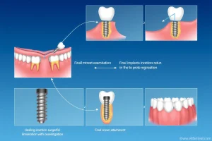A detailed medical illustration showing the step-by-step process of successful dental implant placement, including the initial examination, surgical incision, implant insertion into the jawbone, healing phase with osseointegration, and final crown attachment, all depicted with clear anatomical accuracy and professional clarity