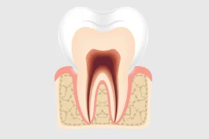 A detailed medical illustration showing a cross-section of a human tooth with inflamed pulp (pulpitis), highlighting the infected dental pulp tissue inside the tooth chamber and root canals, surrounded by healthy dentin and enamel, with subtle redness and swelling indicating inflammation, set against a clean, neutral background suitable for educational use