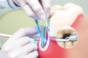 A professional dental implant procedure illustration showing a dentist placing a titanium implant into a jawbone, with a close-up view of the implant integrating with bone tissue, surrounded by dental tools and a clean clinical environment, emphasizing precision and modern dentistry