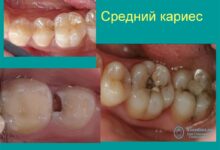 Photo of Лечение кариеса у детей: советы родителям