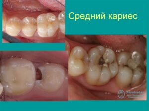 Лечение кариеса у детей: советы родителям
