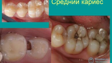 Photo of Лечение кариеса у детей: советы родителям