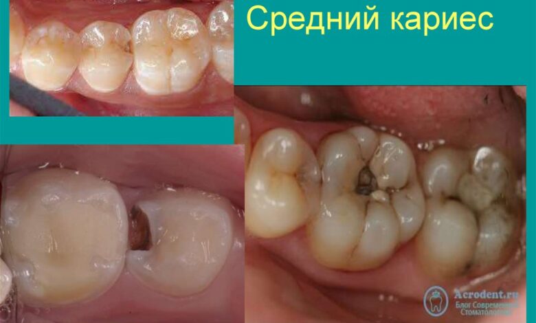 Лечение кариеса у детей: советы родителям