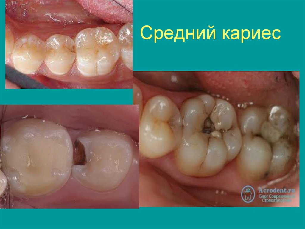 Лечение кариеса у детей: советы родителям