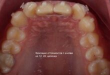 Photo of Инновационные методы отбеливания зубов