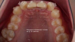Инновационные методы отбеливания зубов