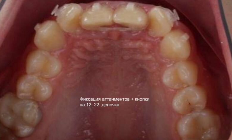 Photo of Инновационные методы отбеливания зубов